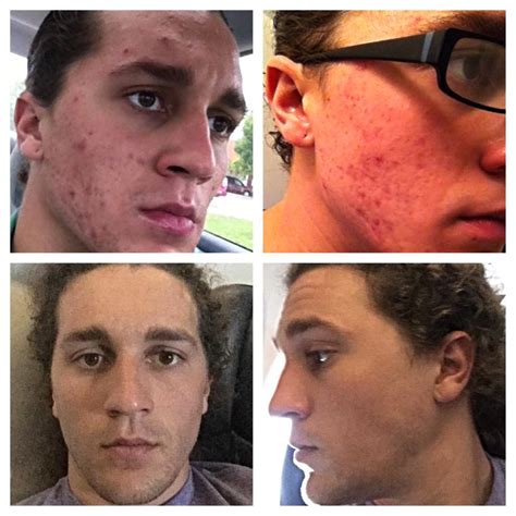 How 50 Different Redditors Cleared Their Acne Using .